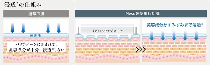 iMeso (アイメソ) 「 ホームケアでも、本格浸透ケアが手軽にできる美顔